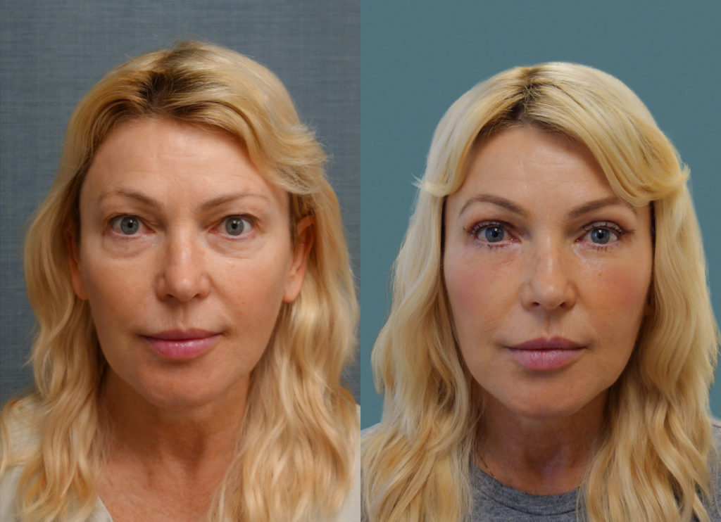 Bilateral Upper and Lower Blepharoplasty, Chemical Peel Lower Eyelids (1 Week Post Op) Patient 05-A 