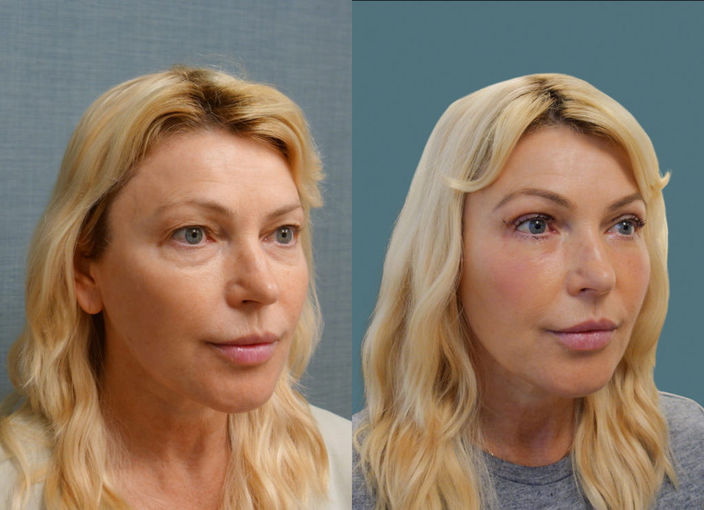 Bilateral Upper and Lower Blepharoplasty, Chemical Peel Lower Eyelids (1 Week Post Op) Patient 05-B 