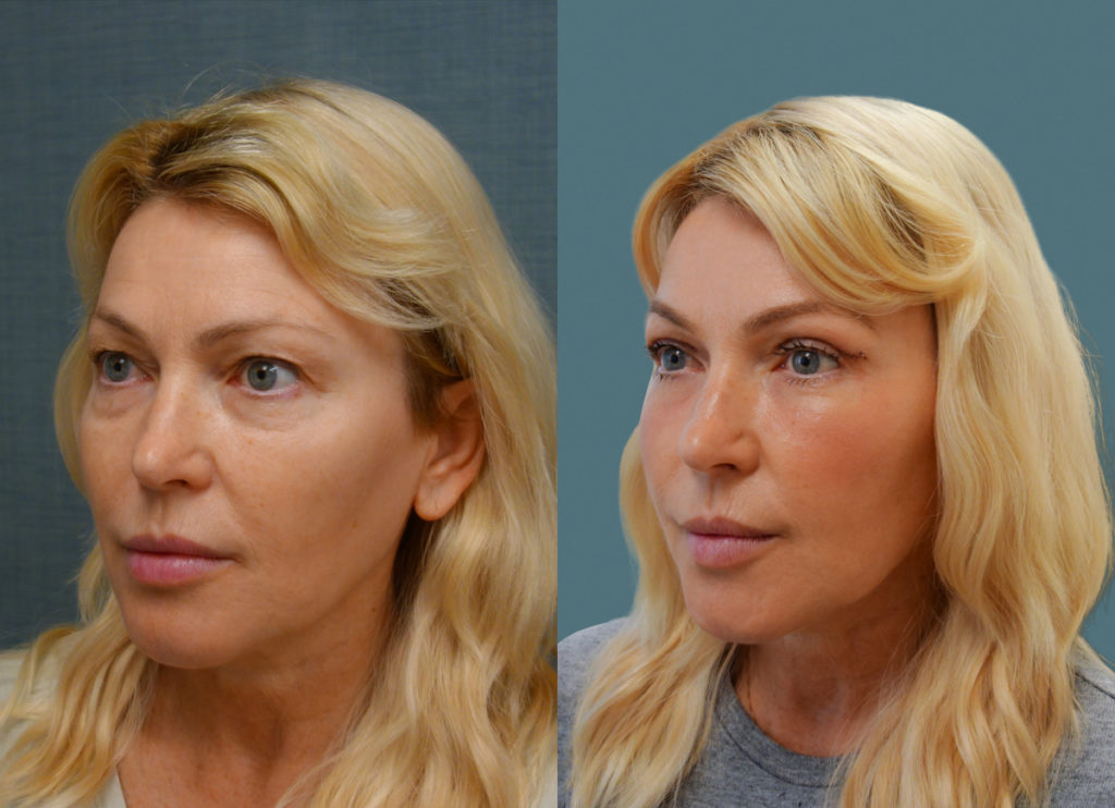 Bilateral Upper and Lower Blepharoplasty, Chemical Peel Lower Eyelids (1 Week Post Op) Patient 05-C 