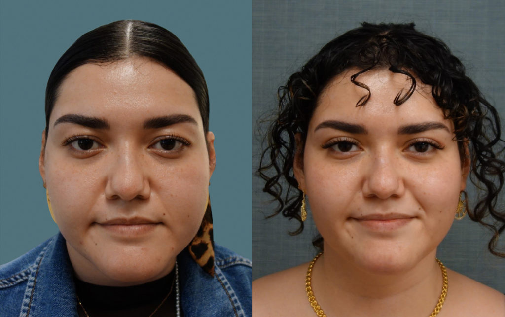 Bilateral Upper Eyelid Blepharoplasty Patient 07-A 