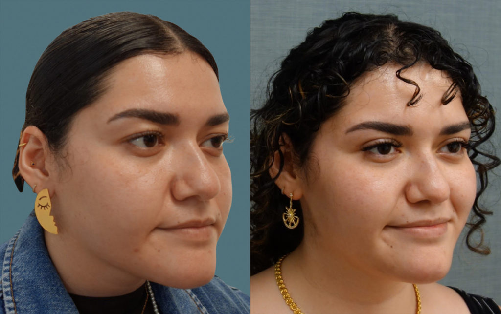 Bilateral Upper Eyelid Blepharoplasty Patient 07-B 