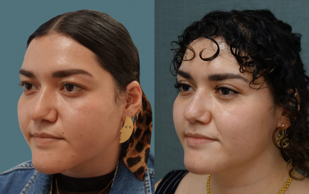 Bilateral Upper Eyelid Blepharoplasty Patient 07-C 