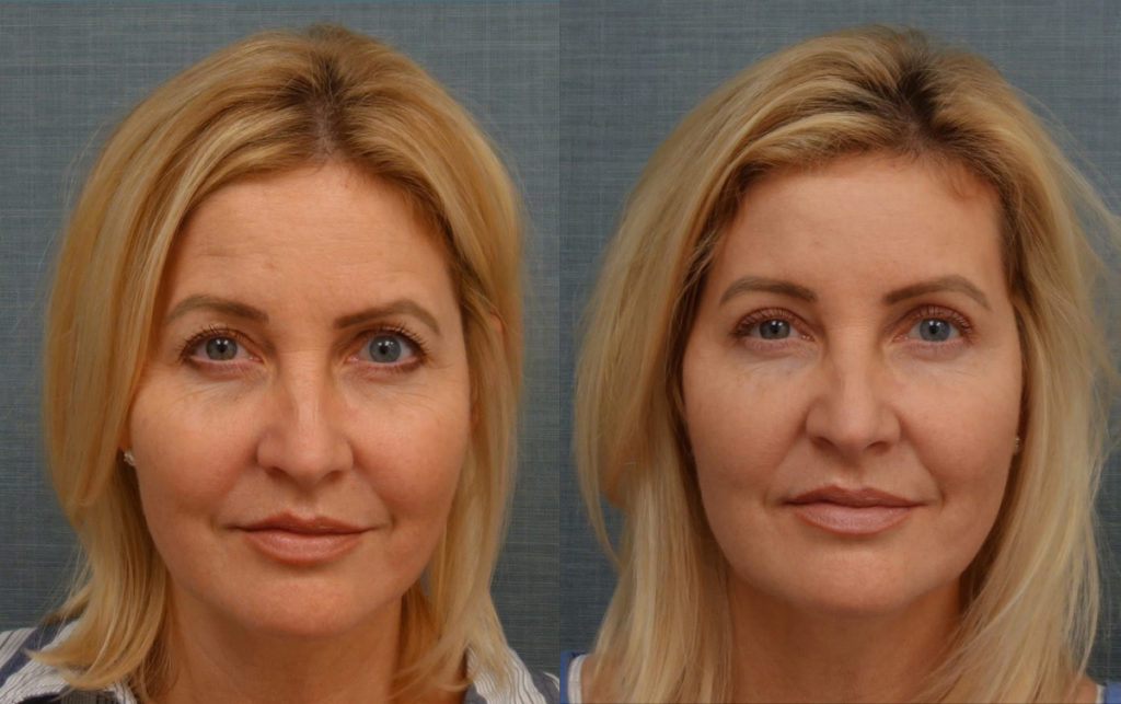 Bilateral Upper Eyelid Blepharoplasty, Bilateral Mini Brow Lift Patient 13-A 