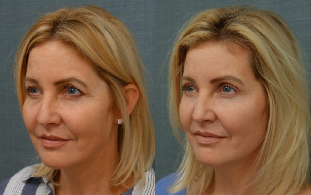 Bilateral Upper Eyelid Blepharoplasty, Bilateral Mini Brow Lift Patient 13-B 