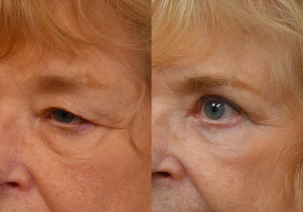 Bilateral Upper and Lower Blepharoplasty, Eyelid Laser Resurfacing Patient 15 