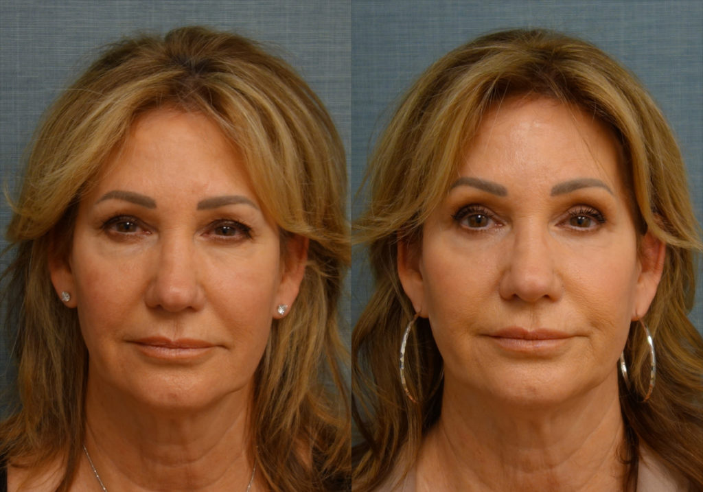 Bilateral Upper and Lower Blepharoplasty, Eyelid Laser Resurfacing Patient 17-A 