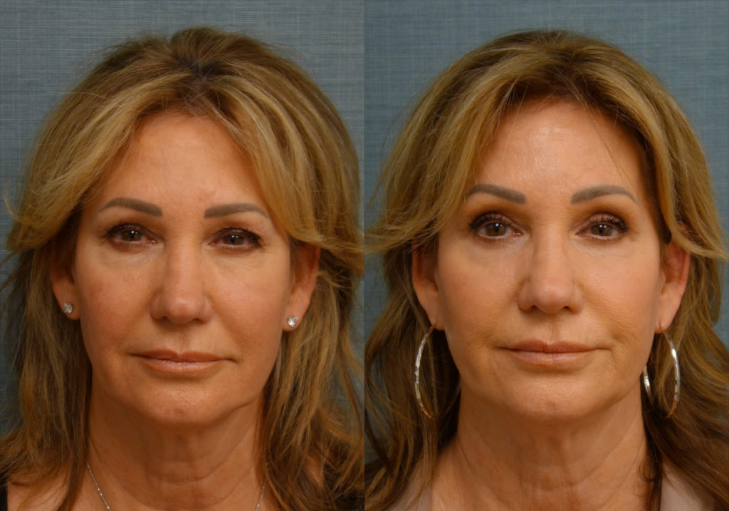 Bilateral Upper and Lower Blepharoplasty, Eyelid Laser Resurfacing Patient 18-A 