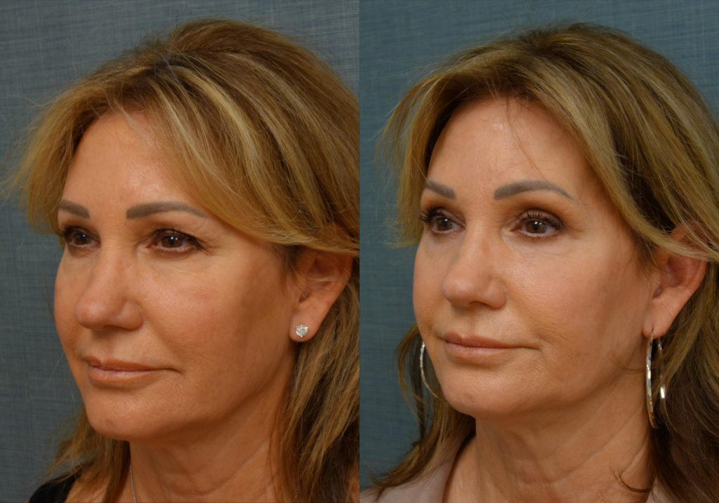 Bilateral Upper and Lower Blepharoplasty, Eyelid Laser Resurfacing Patient 17-B 