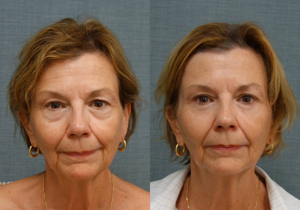 Bilateral Upper and Lower Eyelid Blepharoplasty, Eyelid Laser Resurfacing Patient 21-A 