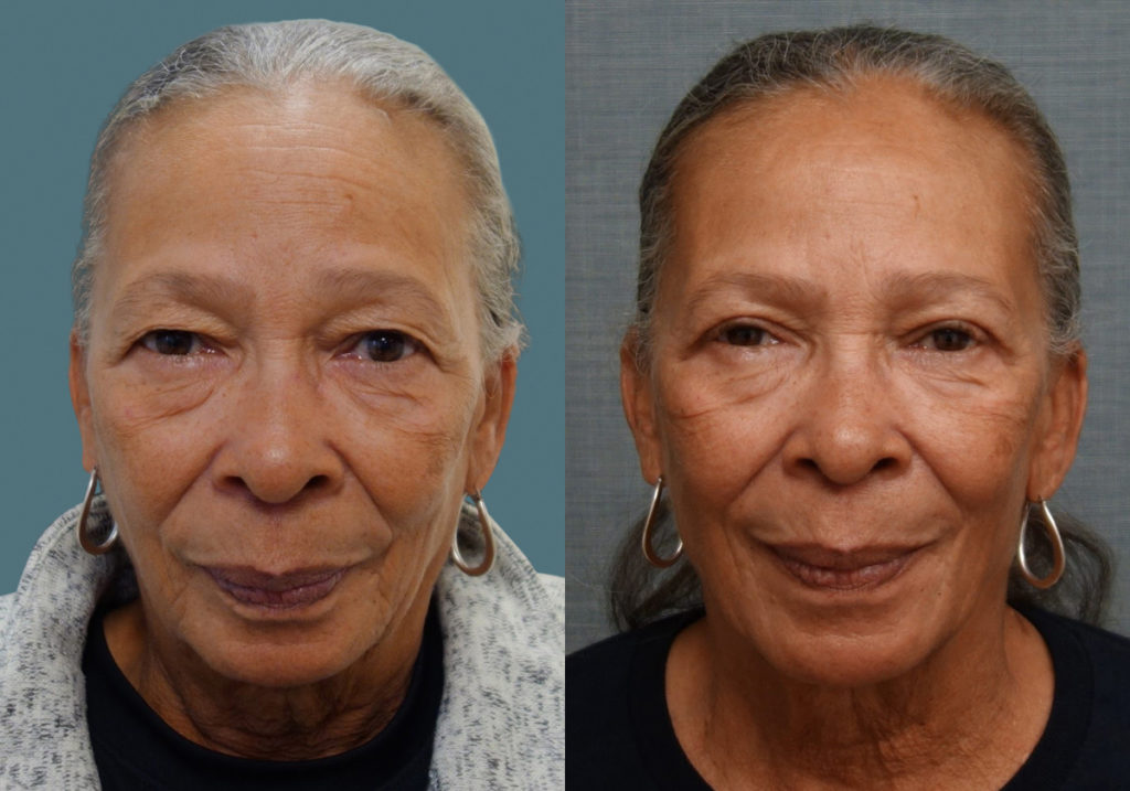 Bilateral Upper Eyelid Blepharoplasty Patient 22-A 