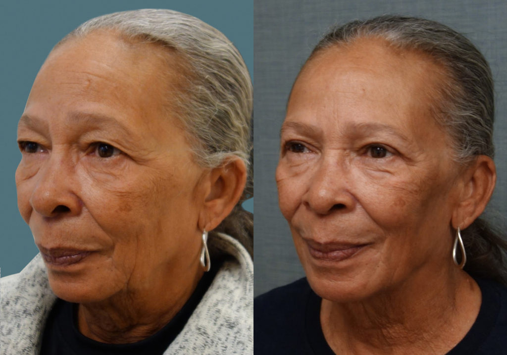 Bilateral Upper Eyelid Blepharoplasty Patient 22-C 