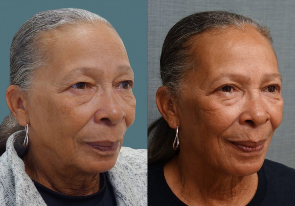 Bilateral Upper Eyelid Blepharoplasty Patient 23-B 
