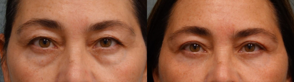 Bilateral Upper and Lower Eyelid Blepharoplasty, Eyelid Laser Resurfacing Patient 26-A 