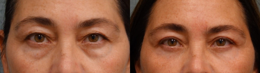 Bilateral Upper and Lower Eyelid Blepharoplasty, Eyelid Laser Resurfacing Patient 27-A 