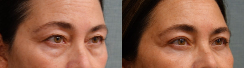 Bilateral Upper and Lower Eyelid Blepharoplasty, Eyelid Laser Resurfacing Patient 27-B 