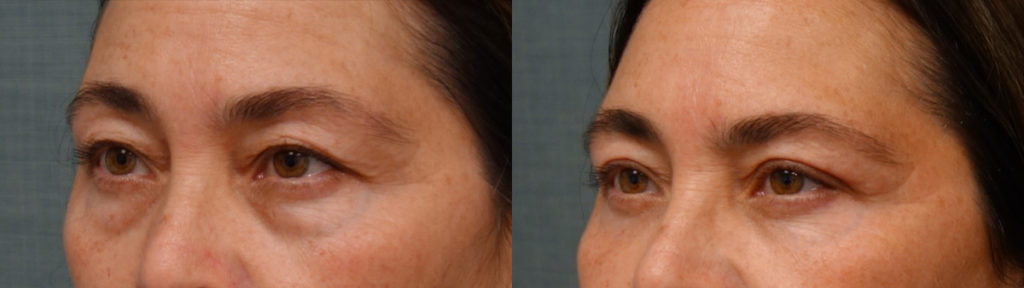 Bilateral Upper and Lower Eyelid Blepharoplasty, Eyelid Laser Resurfacing Patient 27-C 