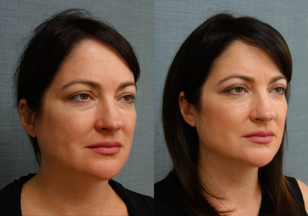 Bilateral Upper Eyelid Blepharoplasty, FaceTite With Micro-Liposuction, Morpheus Microneedling Lower Face Patient 33-A 