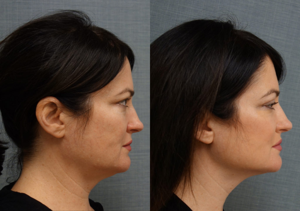 Bilateral Upper Eyelid Blepharoplasty, FaceTite With Micro-Liposuction, Morpheus Microneedling Lower Face Patient 33-B 