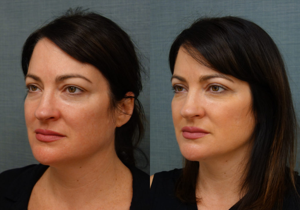 Bilateral Upper Eyelid Blepharoplasty, FaceTite With Micro-Liposuction, Morpheus Microneedling Lower Face Patient 33-C 