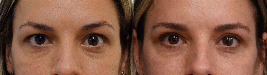 Bilateral Upper Eyelid Blepharoplasty Patient 33-A 