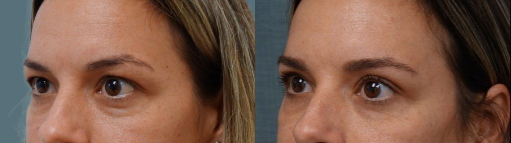 Bilateral Upper Eyelid Blepharoplasty Patient 33-C 