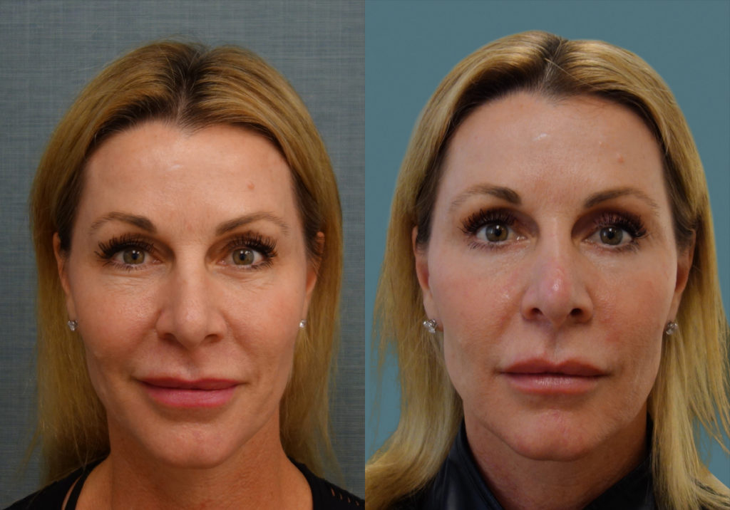 Bilateral Upper and Lower Eyelid Blepharoplasty, Chemical Peel Lower Eyelids Patient 34-A 