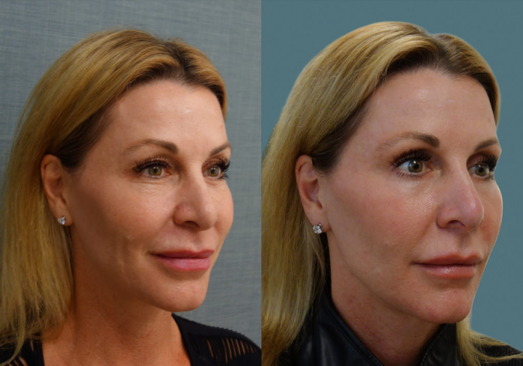 Bilateral Upper and Lower Eyelid Blepharoplasty, Chemical Peel Lower Eyelids Patient 34-B 