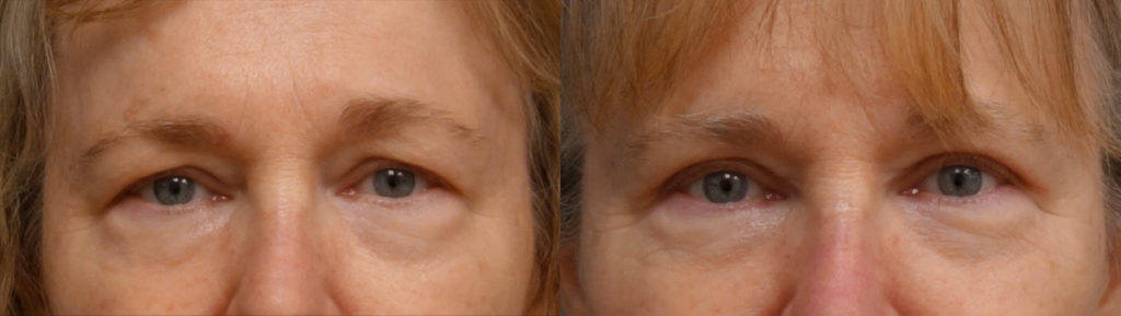 Bilateral Upper Eyelid Blepharoplasty Patient 36-A 