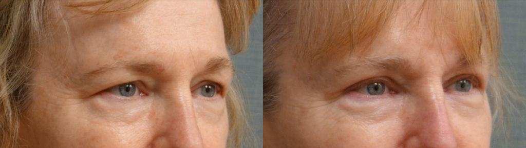 Bilateral Upper Eyelid Blepharoplasty Patient 35-B 