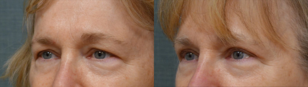 Bilateral Upper Eyelid Blepharoplasty Patient 35-C 