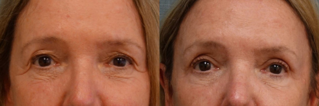 Bilateral Upper Eyelid Blepharoplasty, Bilateral Mini Brow Lift Patient 36-A 