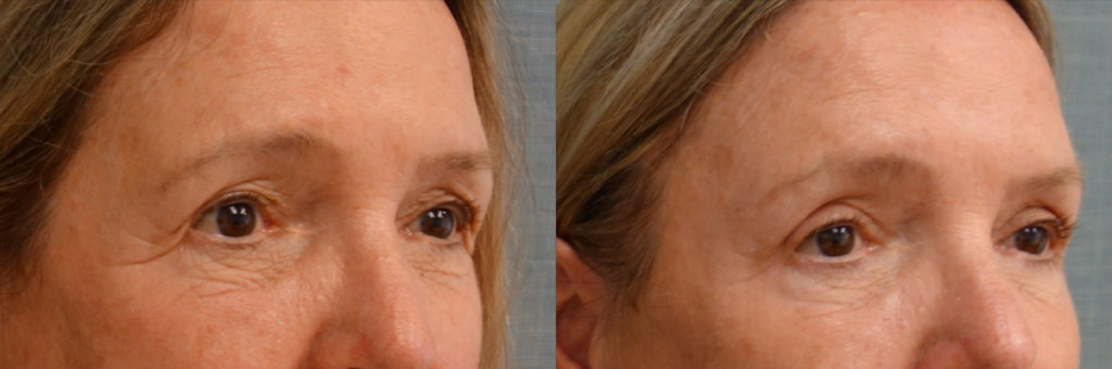 Bilateral Upper Eyelid Blepharoplasty, Bilateral Mini Brow Lift Patient 36-B 