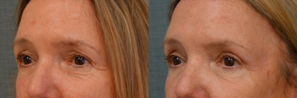 Bilateral Upper Eyelid Blepharoplasty, Bilateral Mini Brow Lift Patient 36-C 