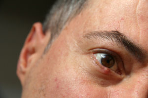 Featured image for What Are the Symptoms of Eyelid Cancer?