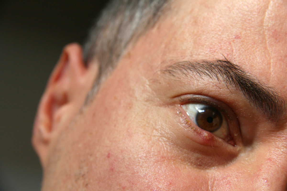 Featured image for What Are the Symptoms of Eyelid Cancer?