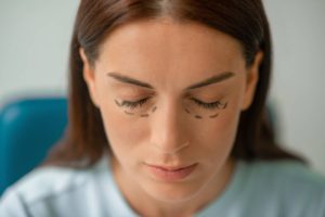 Portrait picture of a woman with incision lines in the eyes area.
