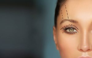 Woman marked in preparation for eyelid surgery.